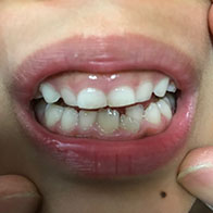 ６歳の娘の下の歯が１本抜けたのですが 永久歯が少し後ろの方から生えてきてしまいました どう考えても抜けた歯の場所には入らない大きさです 矯正治療のスーパーカウンセラー 歯並びtv