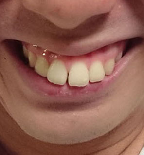 歯の矯正が終わりましたが 上顎が斜めで口元も突出してeラインができないのは整形とか保険が効かない治療で治すしかありませんか 矯正治療のスーパーカウンセラー 歯並びtv
