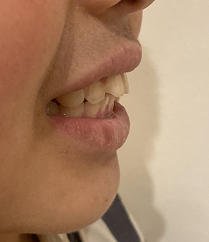 遺伝かとは思うのですが 口元全体がかなり突出しています 出っ歯というよりは上下の歯の位置が全体的に前に出ており 鼻の下で急に段差ができて盛り上がっている状態です 矯正治療のスーパーカウンセラー 歯並びtv