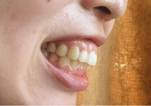 矯正 口元 引っ込み すぎ 抜歯 歯列矯正で、抜歯をすると口元が引っ込みすぎ老ける？